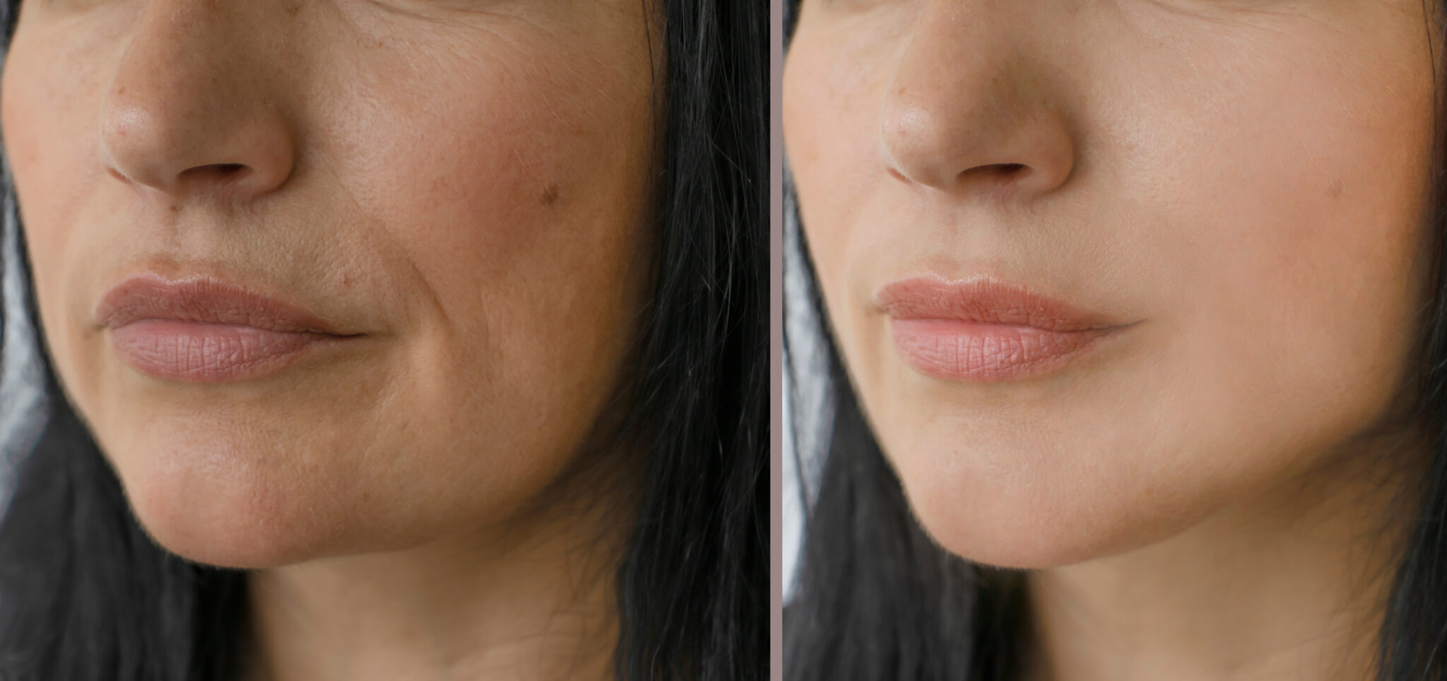 woman face wrinkles before and after