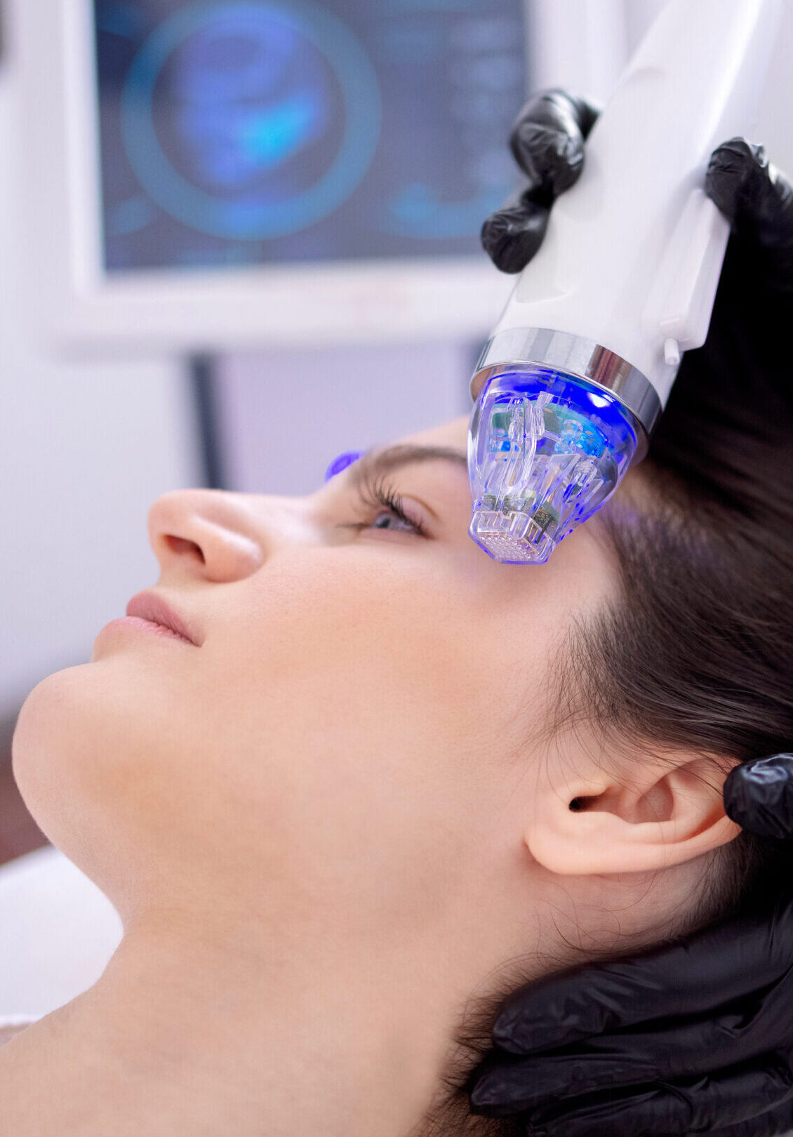 Candela laser treatment at Miracle Wellness